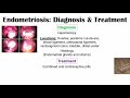 endometriosis causes pathophysiology symptoms diagnosis u0026 treatment