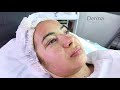 GREEN PEEL TREATMENT -  BEST FOR PIGMENTATION AND SCARS  | Dermacure Clinic