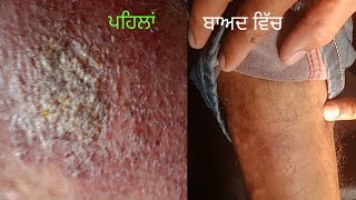 8 ਦਿਨਾਂ ਵਿੱਚ ਚਮੜੀ ਰੋਗ ਠੀਕ ਹੋ ਗਿਆ। Skin Disease Cured Within 8 Days || #skinproblemsolution