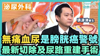 【膀胱癌治療】無痛血尿是膀胱癌警號！了解最新切除及尿路重建手術