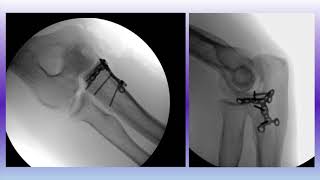 Coronoid Anteromedial Facet Fracture ORIF