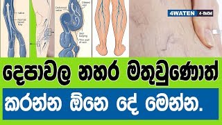 දෙපාවල නහර මතු වුණොත් කරන්න ඕනෙ දේවල් මෙන්න : What should you do if you have varicose veins (2019)