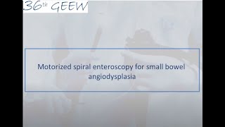 Motorized spiral enteroscopy for small bowel angiodysplasia