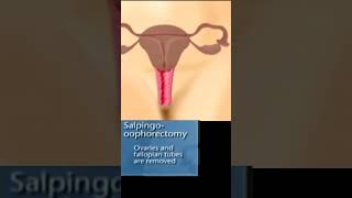 types of hysterectomy # TAh with BSO# total hysterectomy#partial hysterectomy # radical hysterectomy