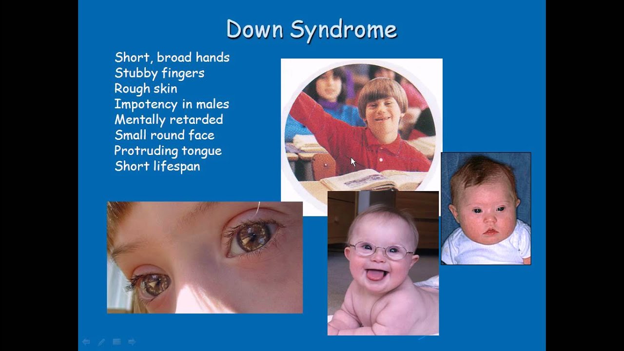 Chromosomal Disorders - YouTube