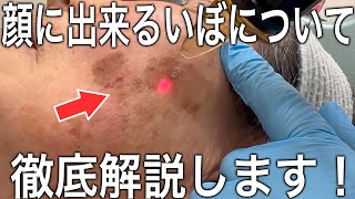 【アンチエイジング】加齢とともに増える老人性イボ（脂漏性角化症）のとり方【2分で解説】