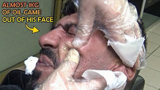 ALMOST 1KG OF OIL CAME OUT OF HIS FACE + EAR BURN AND WAX + CRACKS + Asmr head,face,neck,ear massage