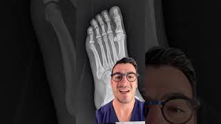 5th metatarsal base fracture - check it out.