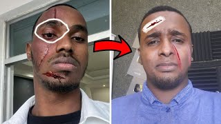 Baangad Madaxa Looga jeexay Dirisle Abdi waxa u sameeyey sababta ka Dambaysa Prank iyo Been fakatay