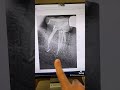 Endodontic retx of tooth #31 through a crown in one visit.