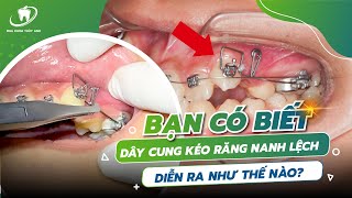 Loại Dây Cung Này Dành Riêng Cho Những Răng Lệch Lạc Nặng