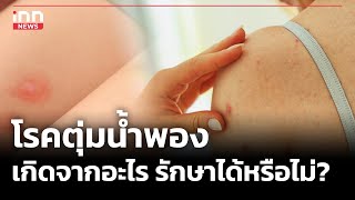 โรคตุ่มน้ำพอง เกิดจากอะไร รักษาได้หรือไม่?