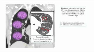 12DaysinMarch, Abnormal CXR Questions and Derivatives for the USMLE Step One Exam