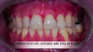 Management of Multiple Recession Defects in the Maxillary Arch