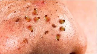 Horrible BLACKHEADS on nose removal