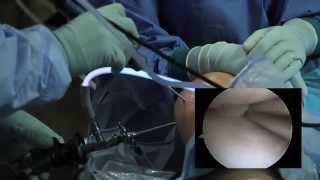 Arthroscopic Knee Surgery Meniscus Tear