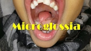 A Rare Case of Microglossia