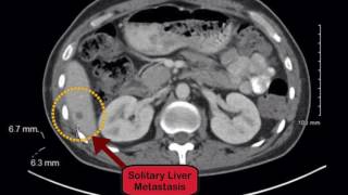 TNM: Understanding the Lung Cancer Staging System