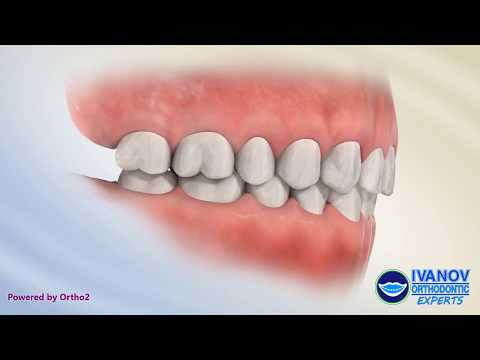 Is it normal for teeth to hit braces?