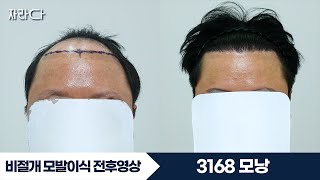 3168모낭 대량이식 M자 헤어라인 #자라다의원