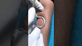 Fractional Co2 Laser For Scar | Fractional CO2 Laser Resurfacing | Skinaa Clinic #shorts #ytshorts