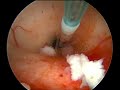 endoscopic aqueductoplasty