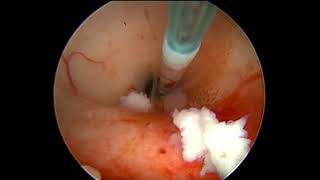 Endoscopic aqueductoplasty