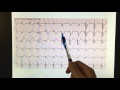 brugada u0026 sgarbossa ekg