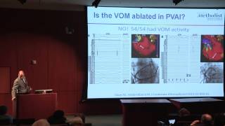 Ablation of the Vein of Marshall for AF Management