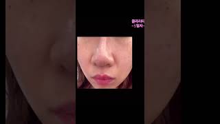 39세..생애 첫 피부과 시술 후기❗️👉클라리티 레이저                더 궁금하신 점은 댓글 남겨 주세요^^#클라리티#레이저#피부과#시술후기