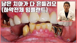 [대전 투명교정, 대전 임플란트] 남은 치아가 다 흔들려요 (하악 전체 임플란트)