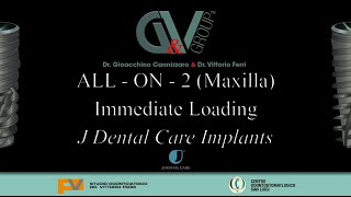 All on 2 maxilla JD Implants