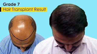 Grade 7 Baldness - Hair Transplant Result | Hair Transformation - Before & After | #hairtransplant