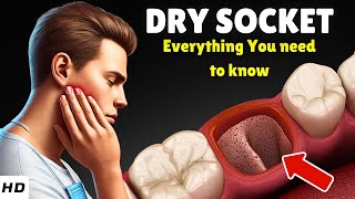 Dry Socket EXPLAINED: Why It Happens, Signs and Symptoms & How to Stop the Pain Fast!