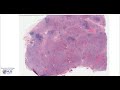 Thyroid: Hashimoto thyroiditis Microscopy - Talking slide