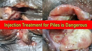 पाइल्स में इंजेक्शन हो सकता है खतरनाक | Injection Treatment for Piles is Dangerous