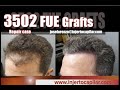 3502FUE Grafts. Difficult repair case. Scar repair/plugs extraction. Injertocapilar.com2286/2018