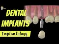 DENTAL IMPLANTS : INTRO and ADVANTAGES, OSSEOINTEGRATION EXPLAINED