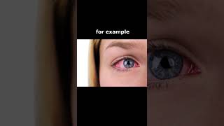 Eye Symptoms - Light Sensitivity