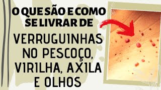 O que são e como se livrar de verruguinhas no pescoço, virilha, axila e olhos