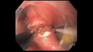 New Therapeutic Endoscopic Techniques