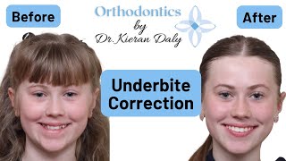 Underbite Correction