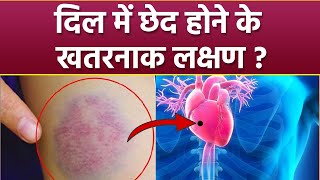 दिल में छेद होना खतरनाक जानिए कारण लक्षण । Dil Me Ched Ke Karan Or Lakshan । Boldsky *Health