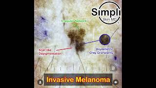 Invasive Melanoma Dermoscopy