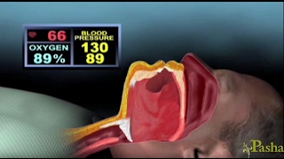 Transoral Robotic Surgery for Sleep Apnea