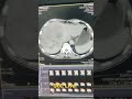 Triphasic Liver| SOL Liver | routine case | HCC