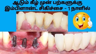 ஆடும் கீழ் முன் பற்களுக்கு இம்பிளான்ட் சிகிச்சை 1 நாளில். Teeth implant cost in Tamil