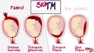 Third Trimester Vaginal Bleeding