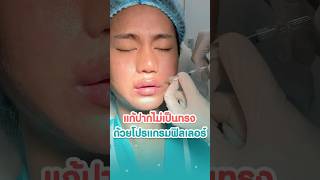 แก้ปัญหาริมฝีปากไม่เป็นทรง ด้วยการฉีดฟิลเลอร์ #ฟิลเลอร์ #Filler #รีวิวฉีดฟิลเลอร์คริสตัลคลินิก