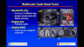 Pediatric Renal Tumors Usual and Unusual